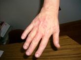 Hand Eczema after